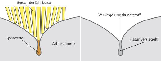 Vorgang der Fissurenversiegelung