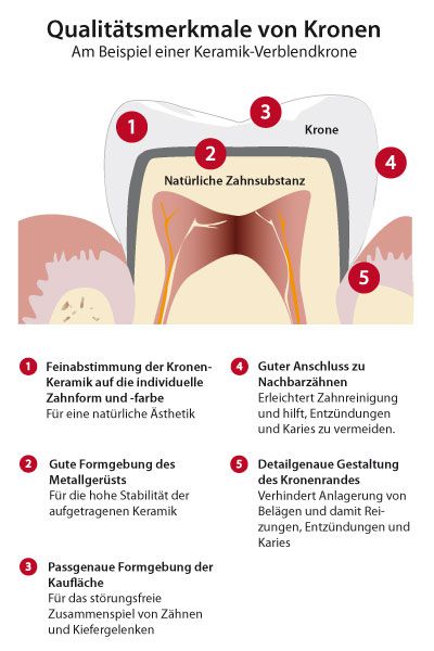 Qualitätsmerkmale bei Kronen